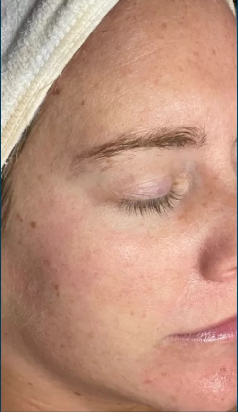 Patient Before SkinPen Treatment