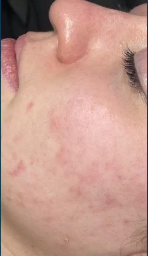 Patient Before SkinPen