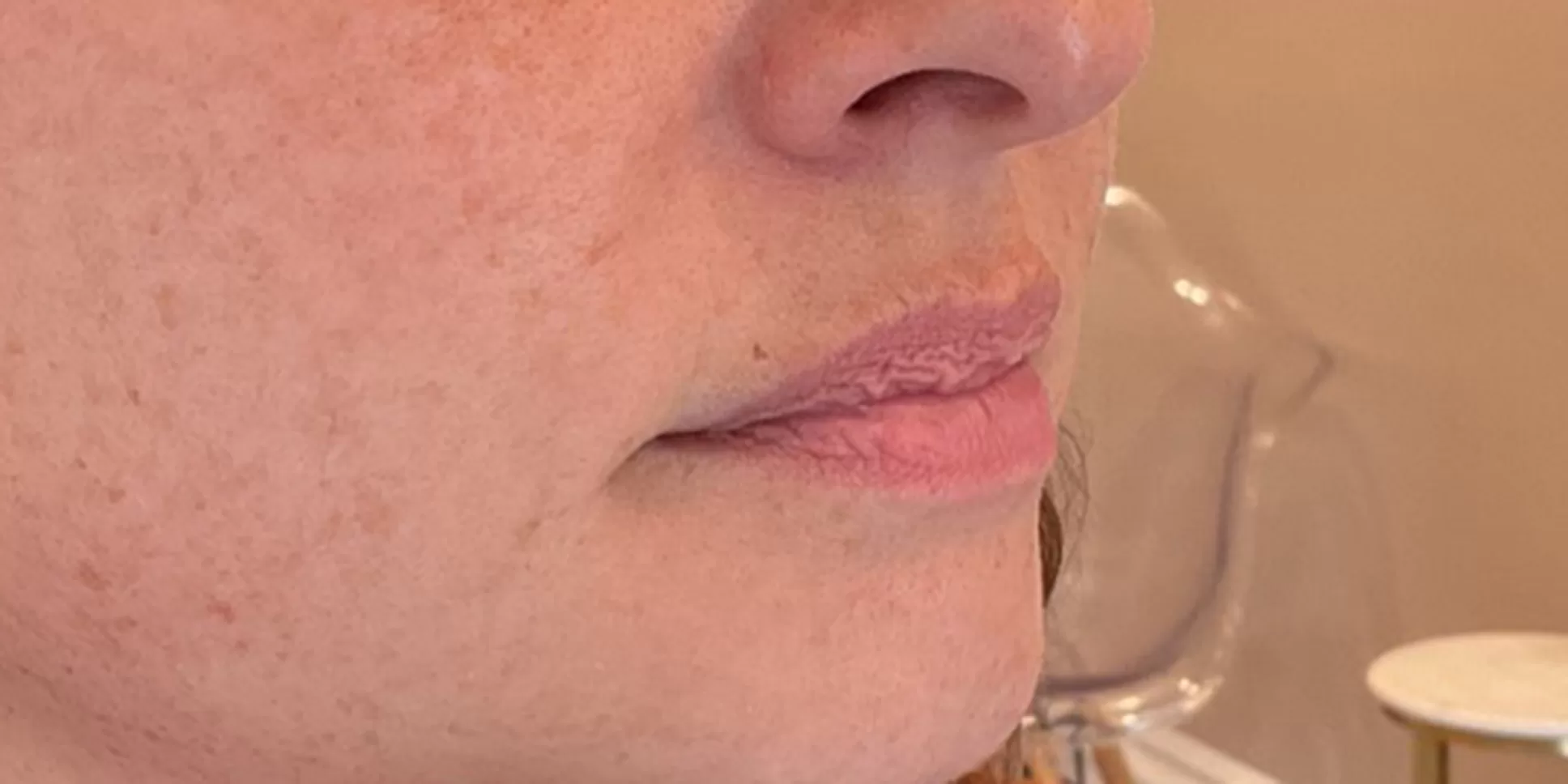 Before Lip Filler Treatment