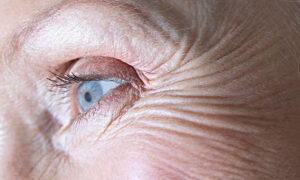 female with crow's feet wrinkles around eyes