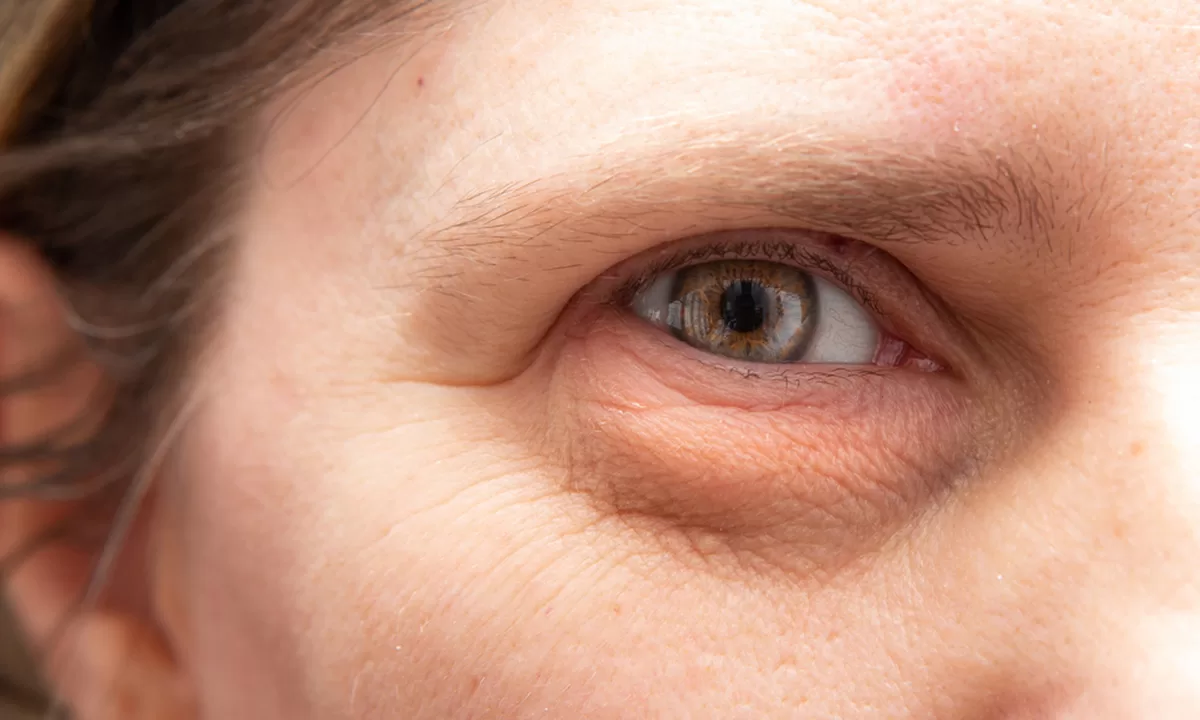 closeup of female with droopy eyelids (ptosis)