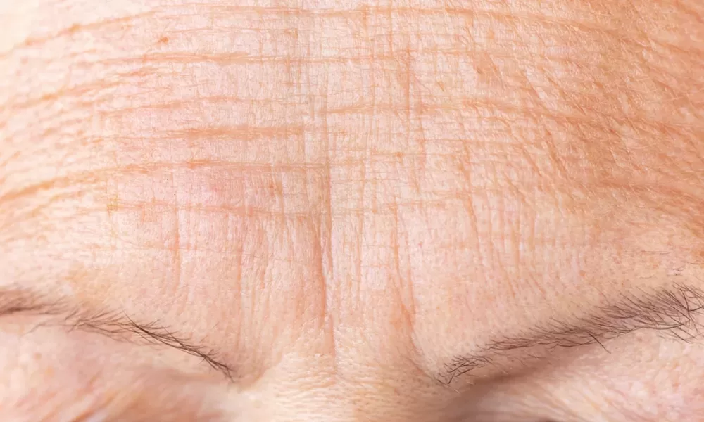 close up of forehead lines on female