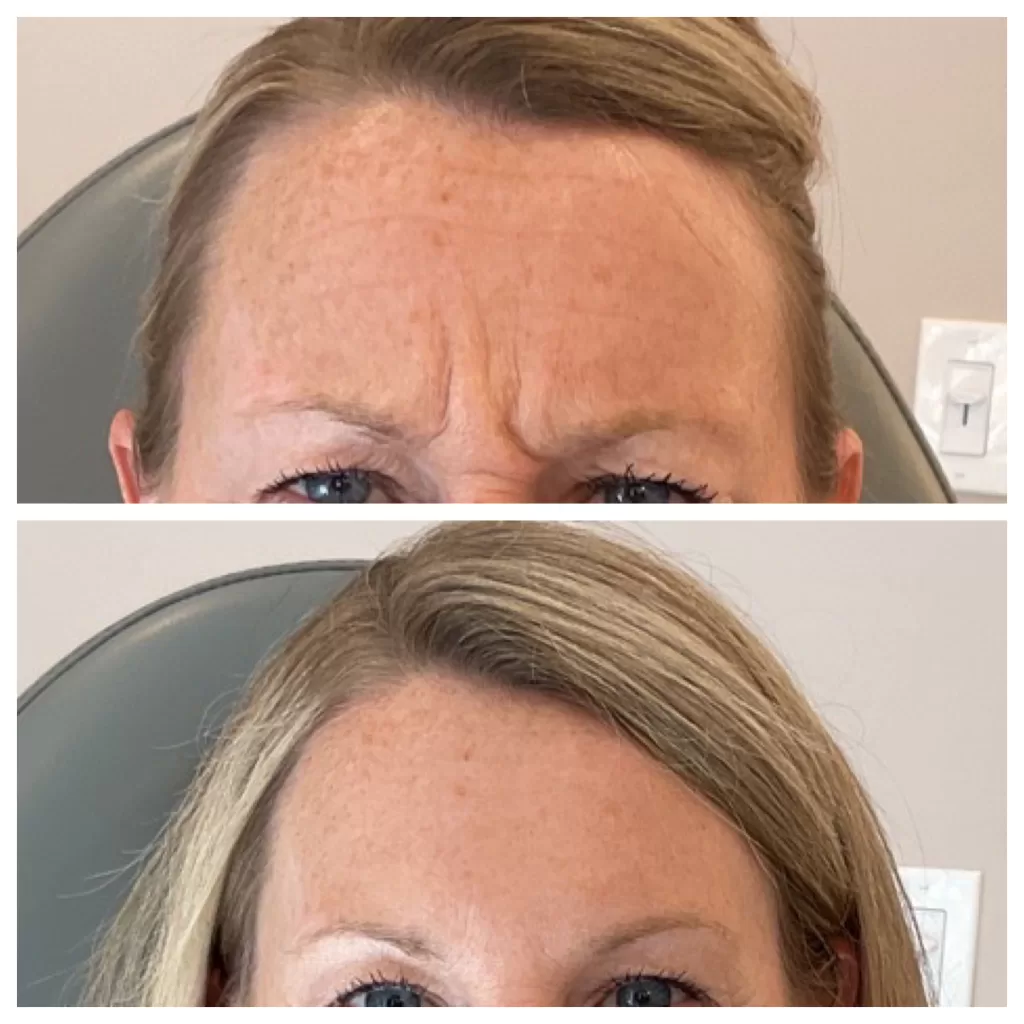 close up of a females forehead wrinkles before getting botox for forehead and a close up of the females wrinkles after botox