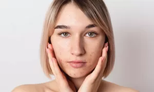 Female with Hormonal Acne on face