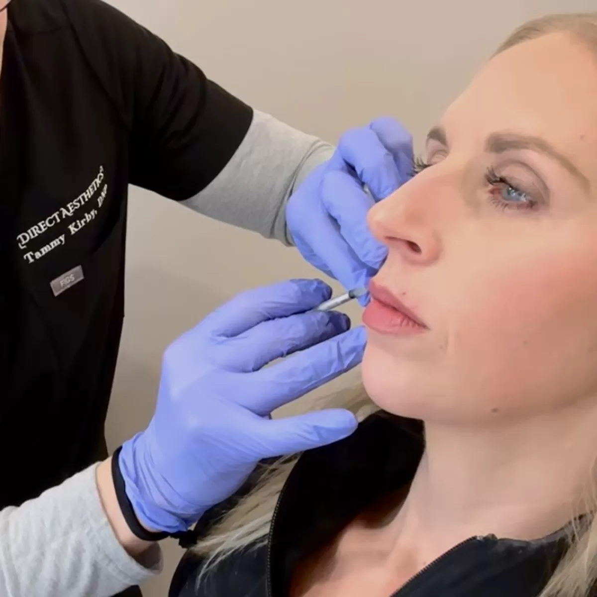 female patient receiving botox for lip lines