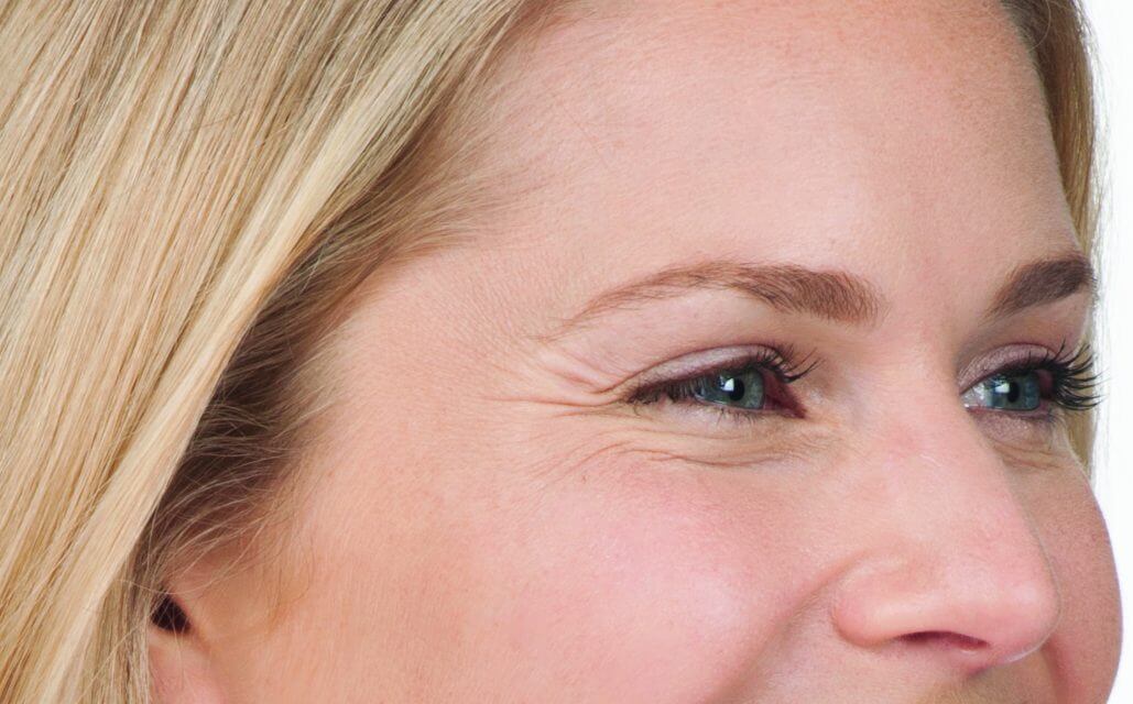 female demonstrating appearance of crow's feet while smiling