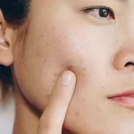 female with acne as a result of retinol purging
