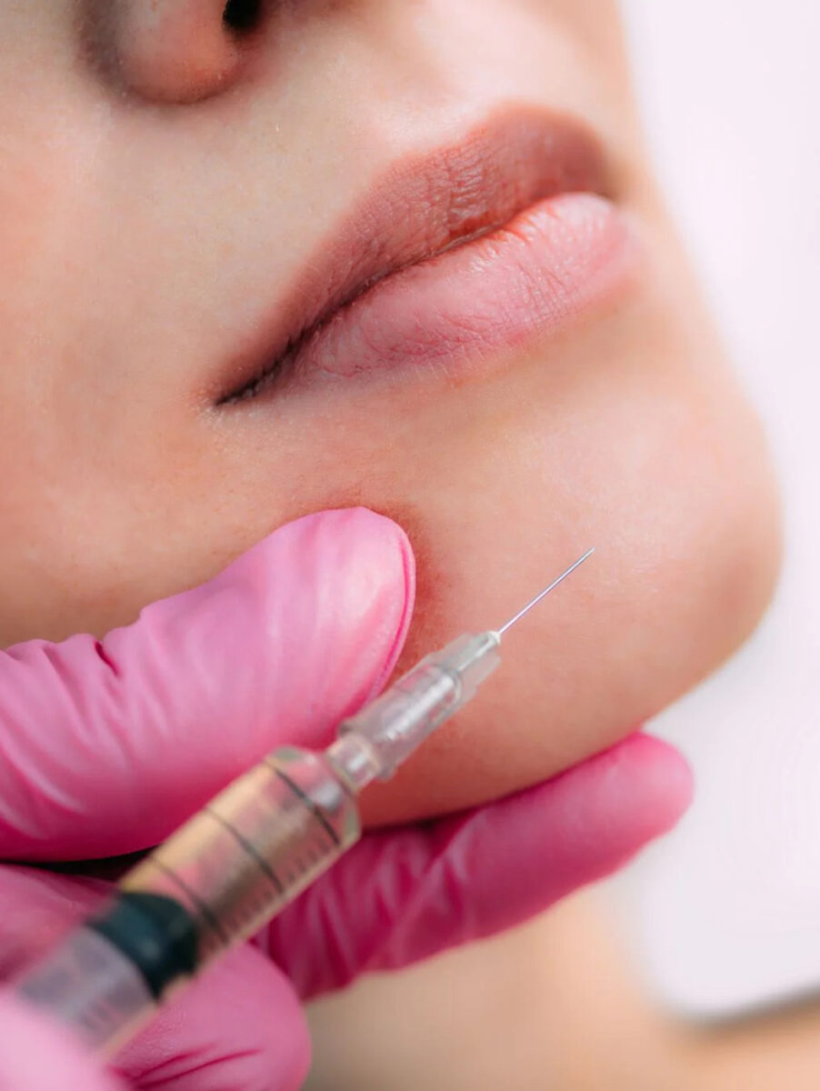 close up of female injected with filler in chin