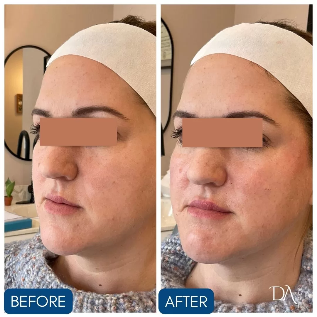 female patient before and after facial balancing treatments