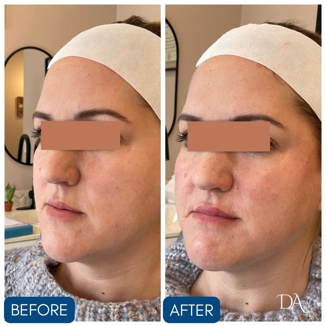 female patient before and after facial balancing treatments