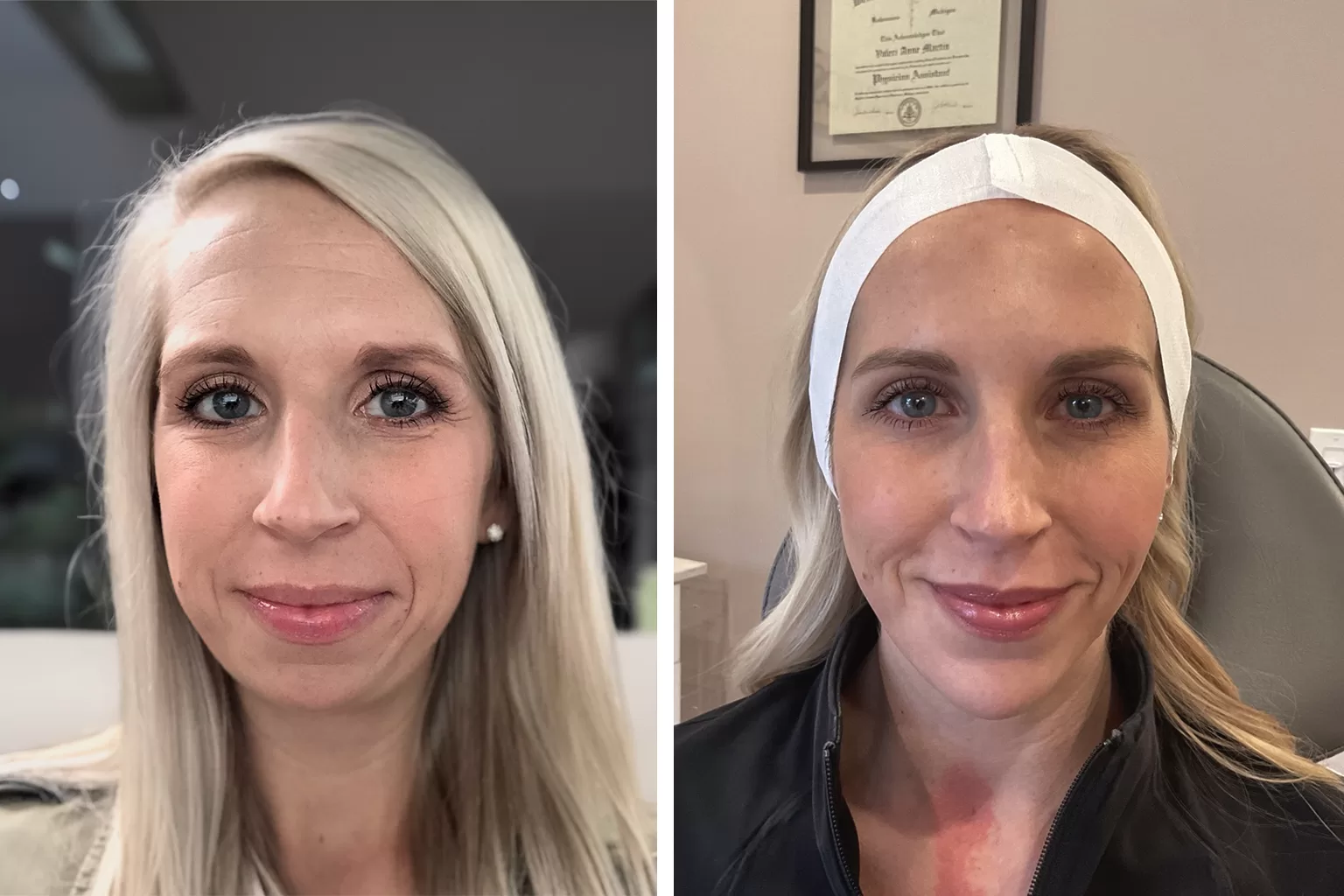 female patient before and after headshot photos of facial balancing