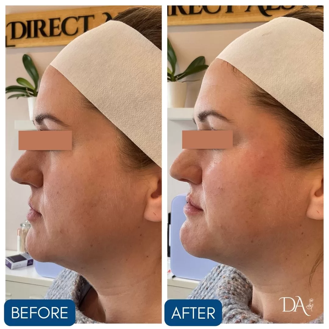 female facial balancing before and after left profile