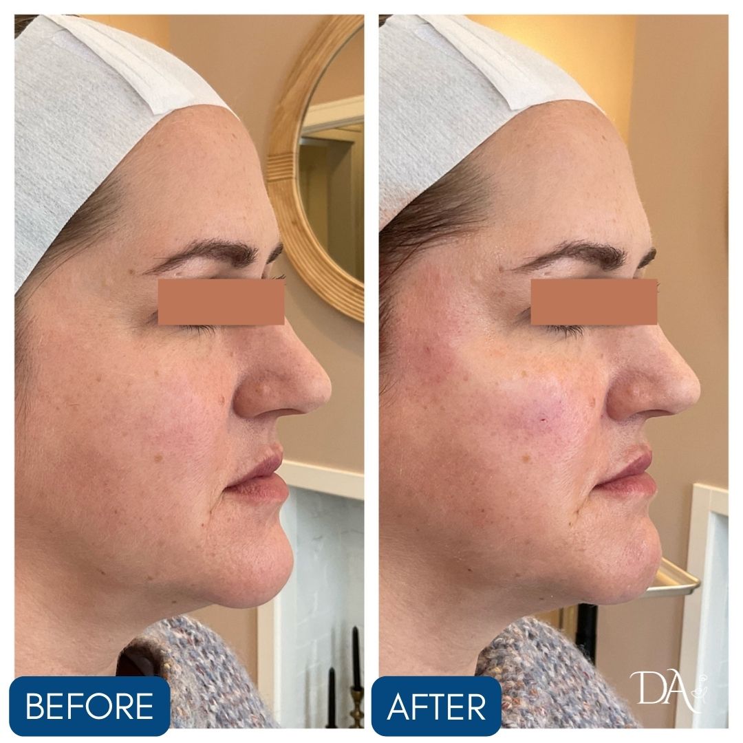 female facial balancing before and after right profile