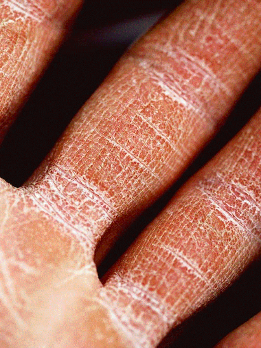 close up of dry skin on hands and fingers