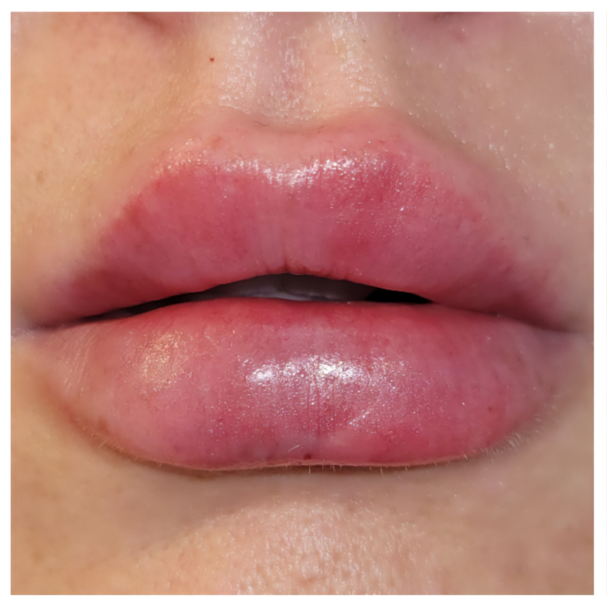 close up image of swollen lips, slightly uneven, no bruising yet.