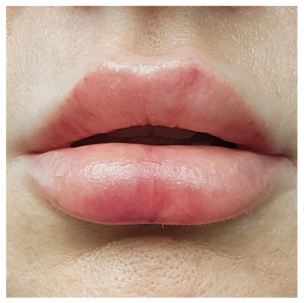 Swelling has increased, making the lips look tender and puffy.