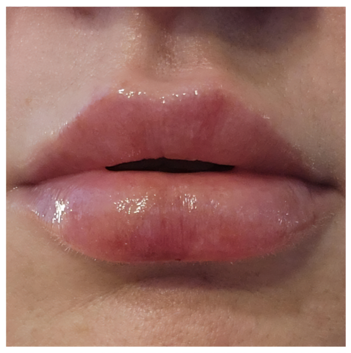 Close-up of lips on the fifth day after lip filler injections.