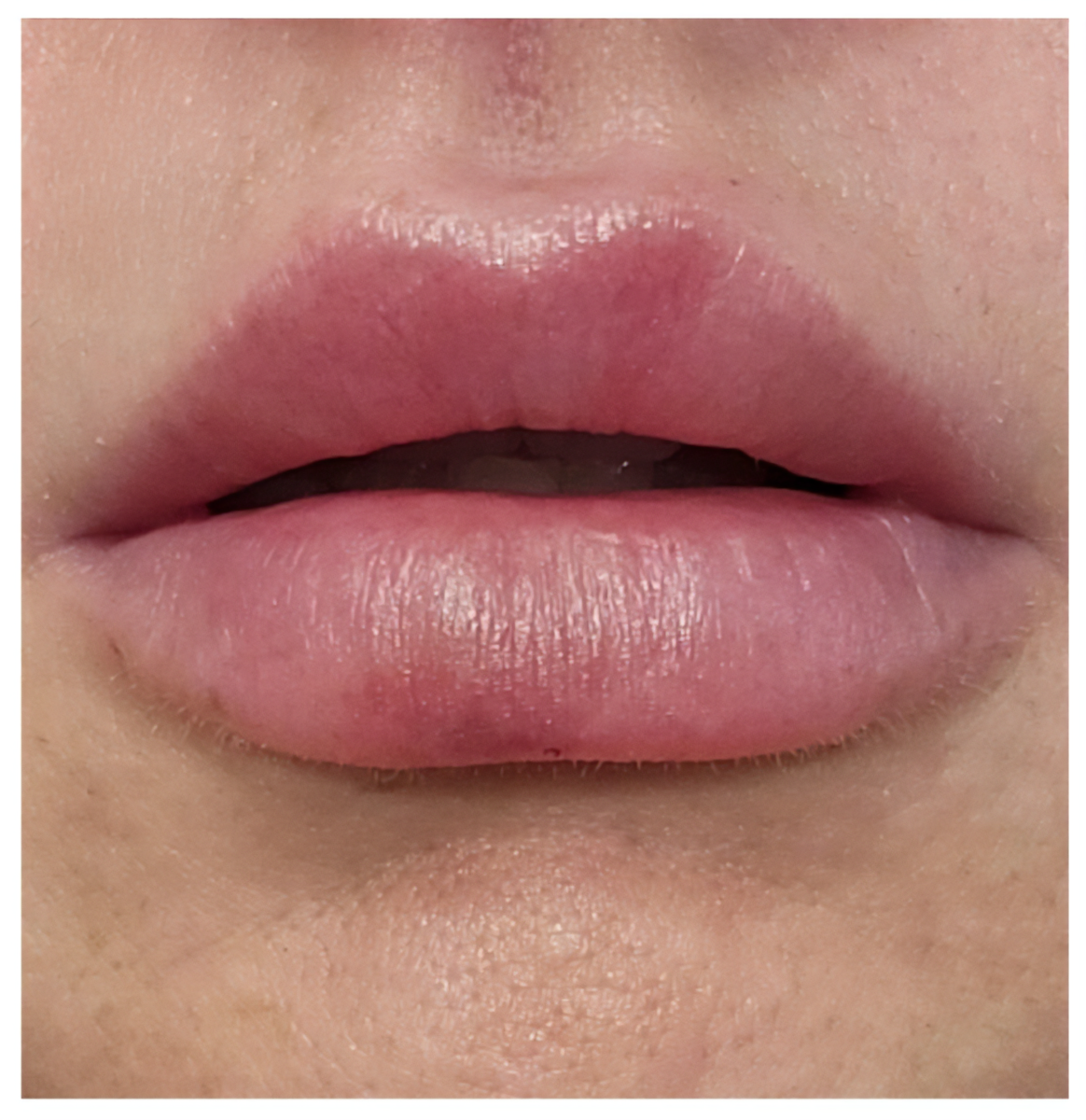 close-up image of lips where swelling is nearly gone, and the lips have a more balanced shape.