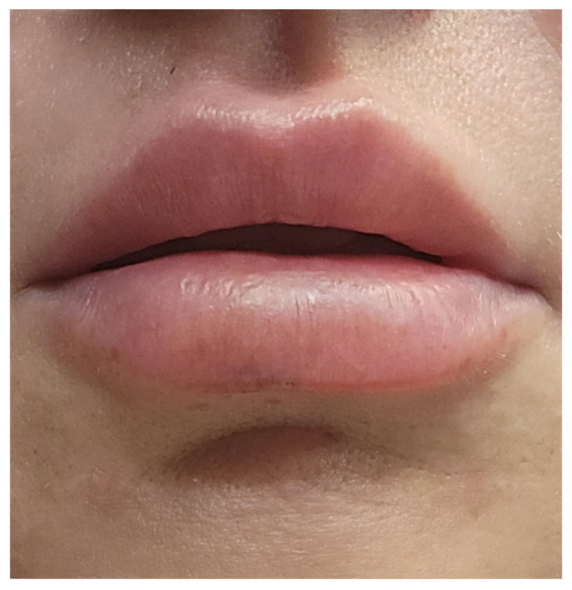 Close-up of lips on the eighth day after lip filler injections.