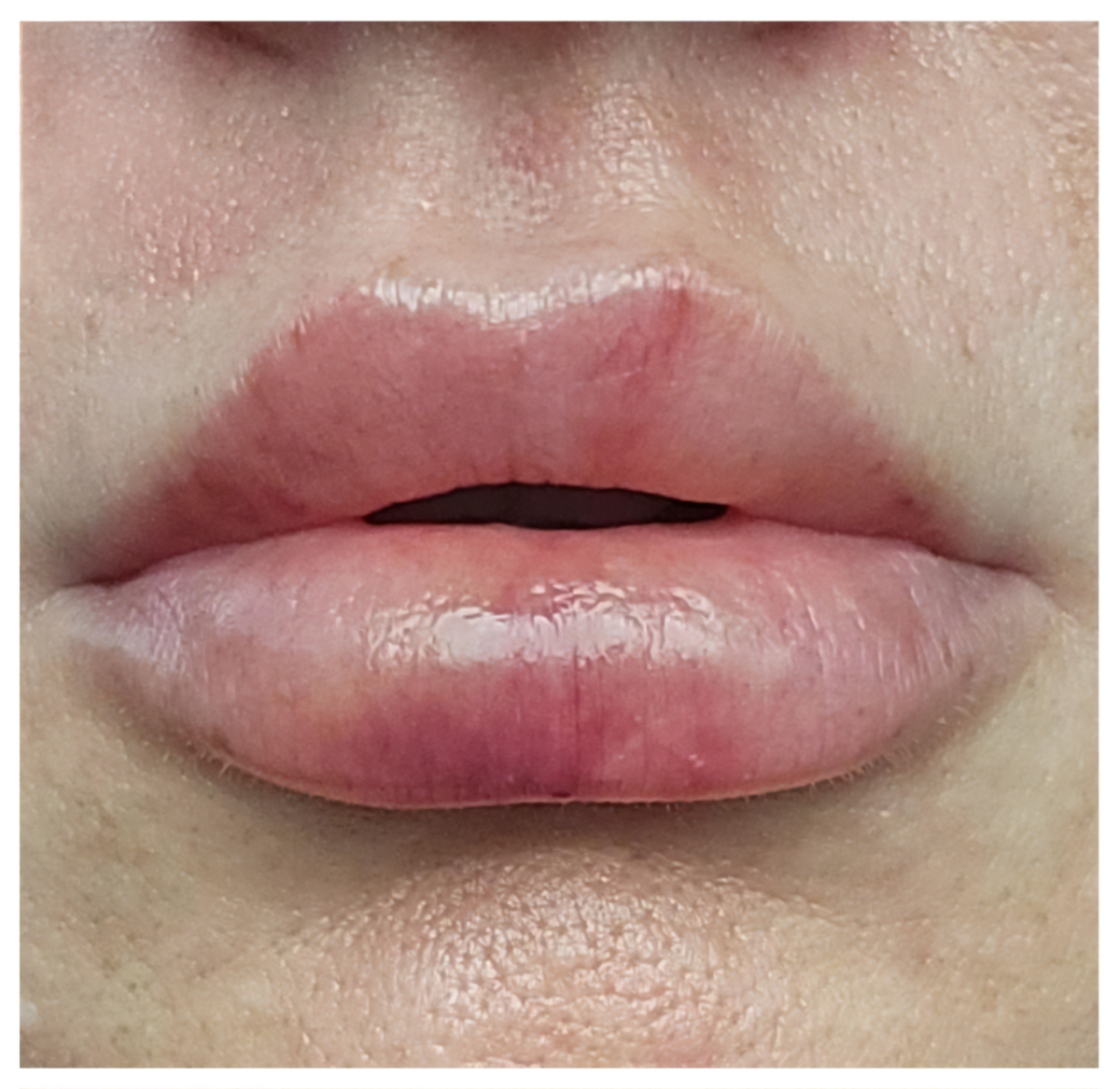 Close-up of lips with peak swelling, mild bruising starts to appear.