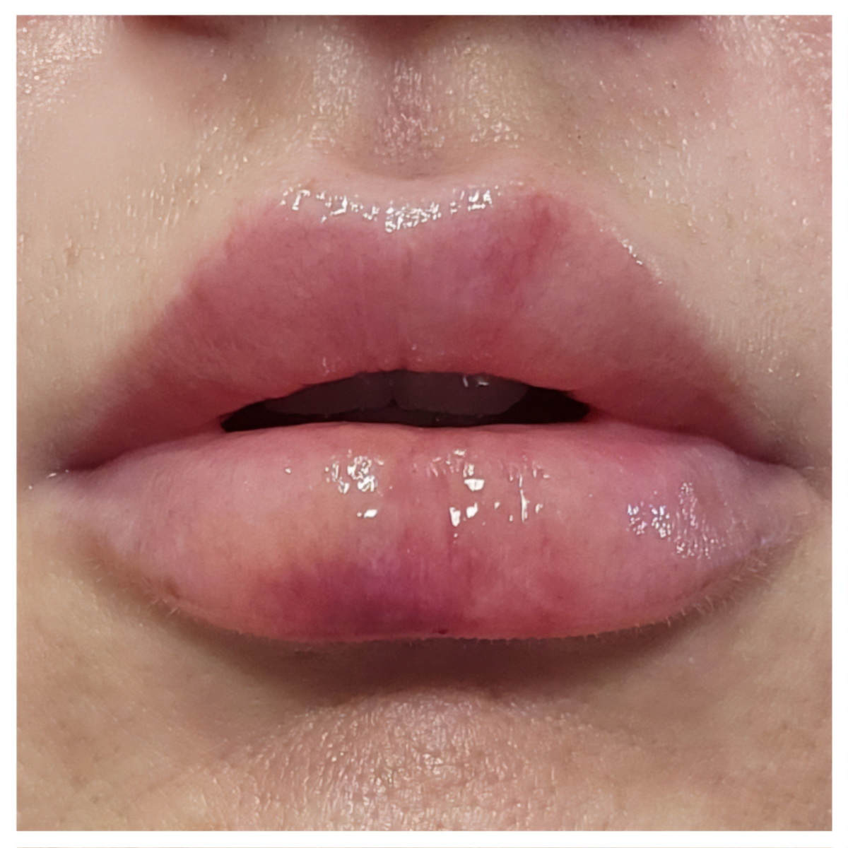 Close-up of lips where swelling is reducing, but bruising is now more visible.