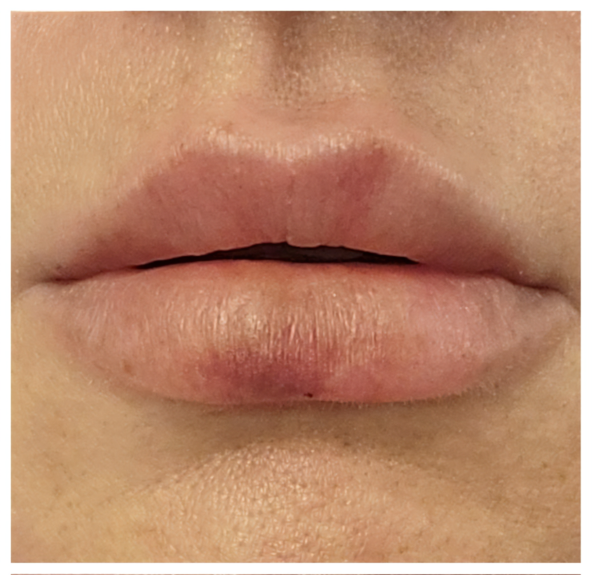 Close-up of lips with minimal swelling, fading bruises visible.