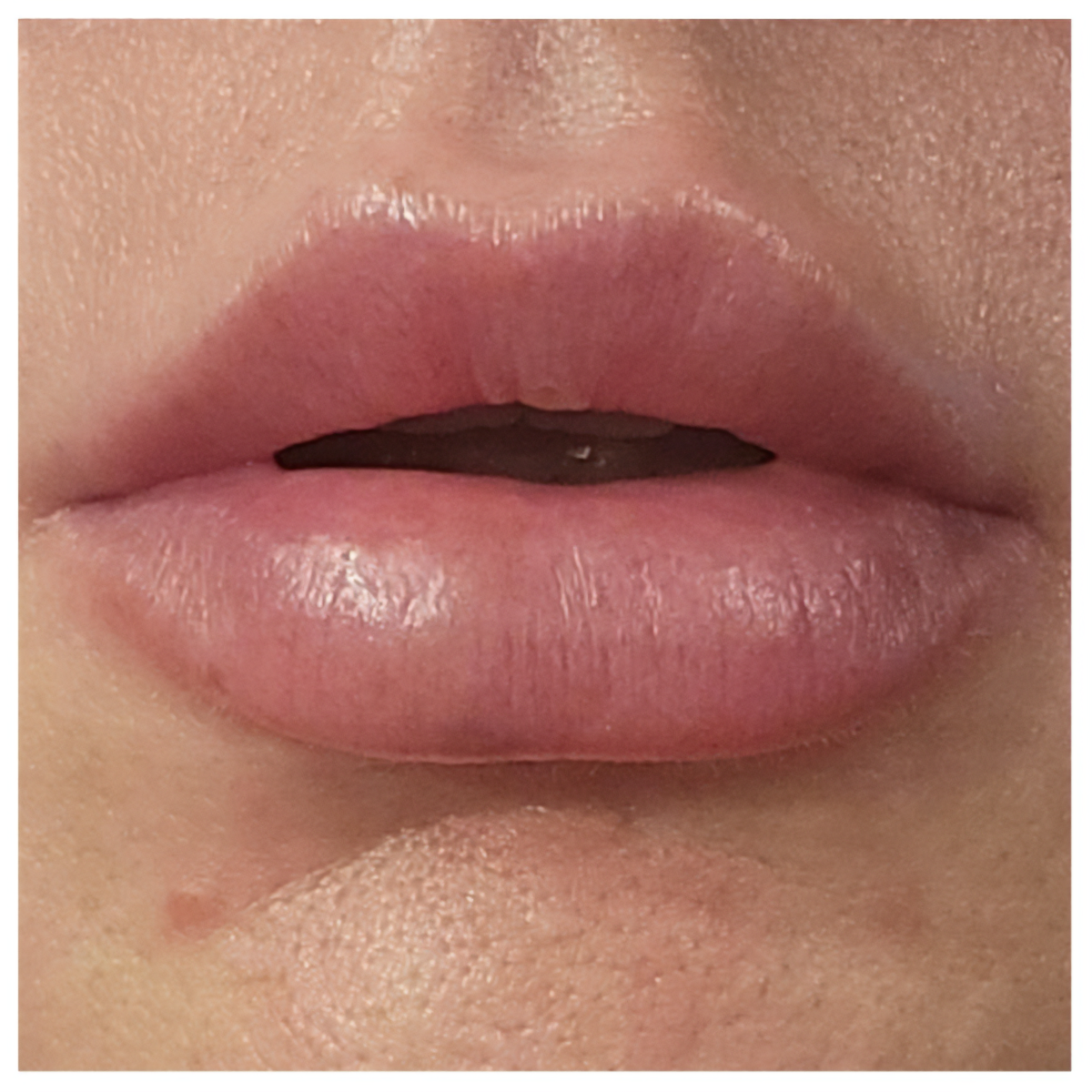 Close-up of fully healed lips, no swelling or bruising.