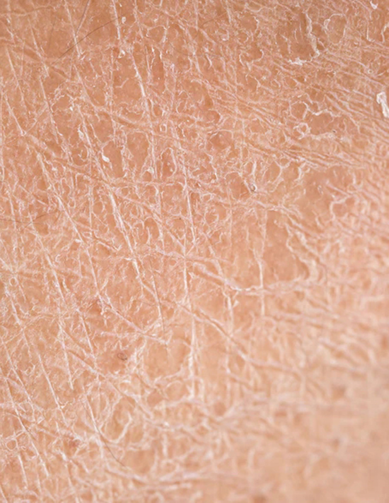 A close up image of dry skin