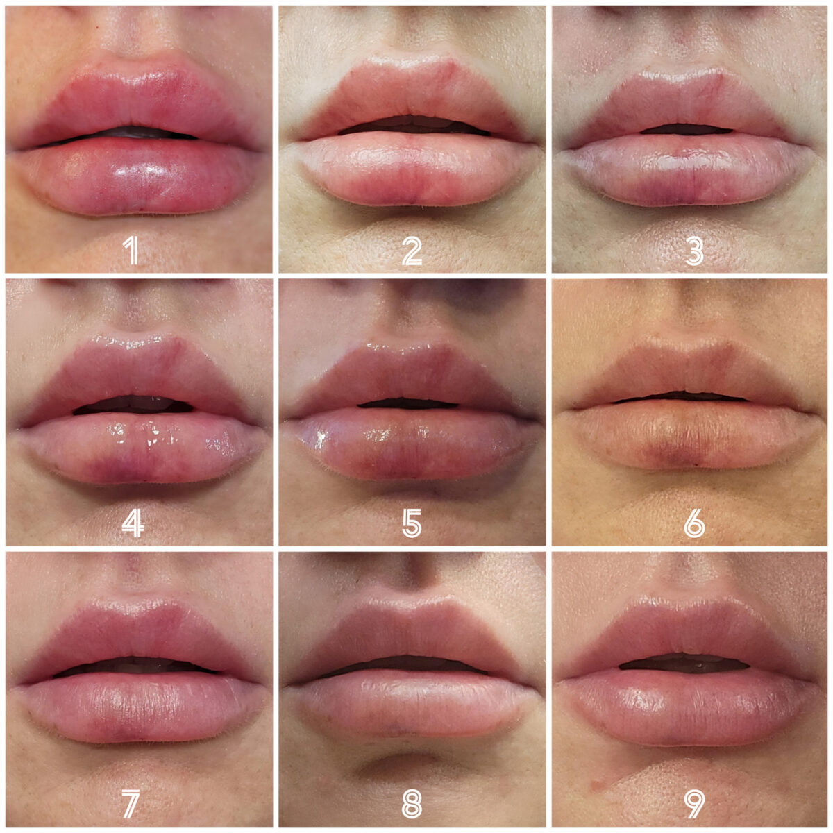 grid of 9 day-by-day images of lip swelling during healing process