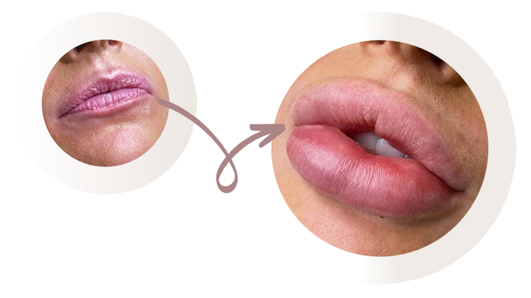 Lip filler before and after