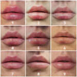 lip filler healing process timeline