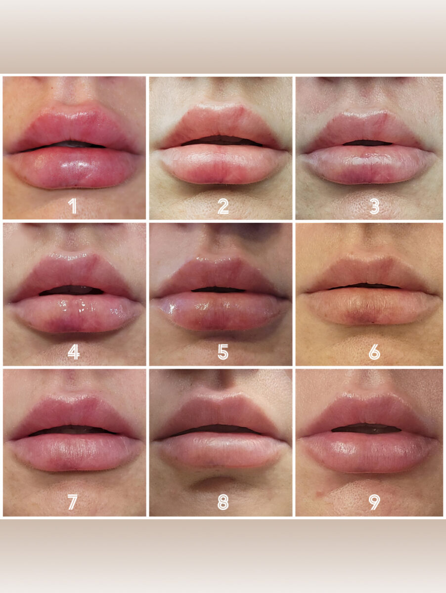 lip filler healing process timeline